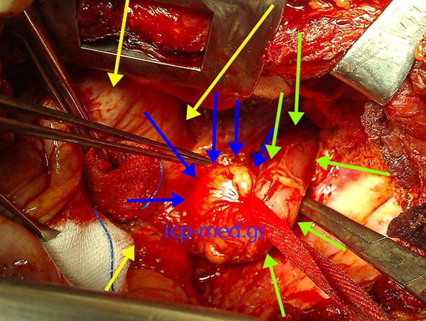 6. Intraoperatively the hiatal hernia aka the 'intrathoracic fundus of stomach' (BLUE). GREEN: oesophagus, YELLOW: diaphragm