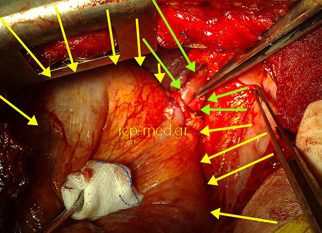 8. Intraoperatively Post repair: there is no longer any part of the stomach inside the chest (GREEN: oesophagus, YELLOW: diaphragm)