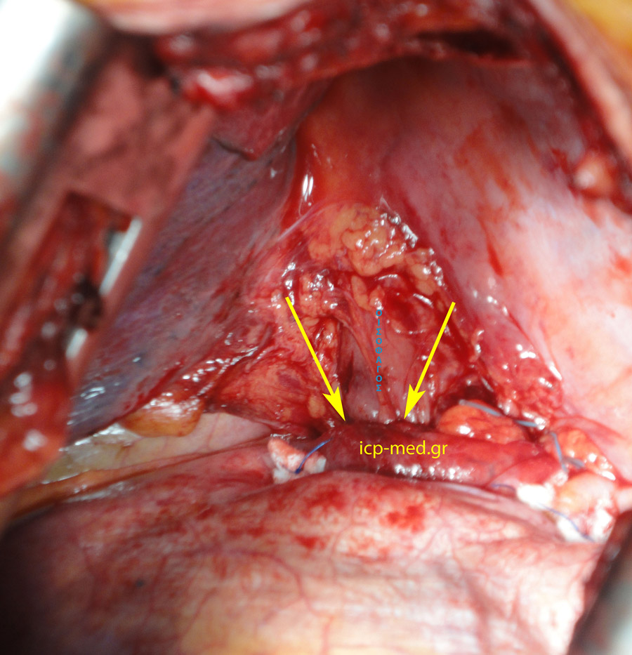 10. Intraoperatively Post repair: there is no longer any part of the stomach inside the chest (BLUE: oesophagus, YELLOW: the hiatus of the diaphragm)