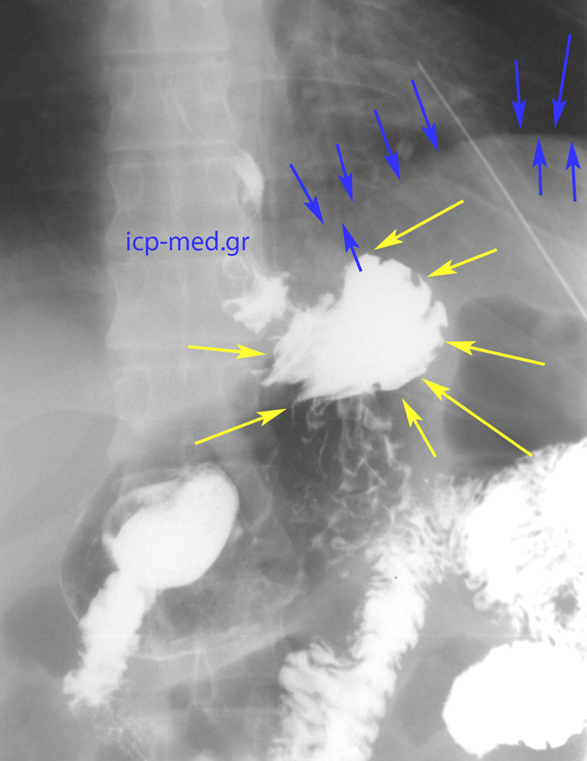 12. Postop radiologic image: there is no longer any intrathoracic stomach (BLUE: diaphragm, YELLOW: intraabdominal stomach)