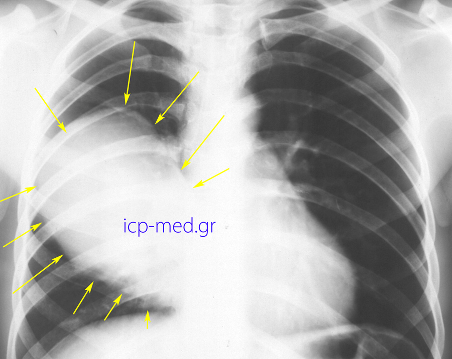 1. Preop CXR (anteroposterior): Gigantic Hydatid Cyst (18 x 12 cm, YELLOW arrows) of the right lung