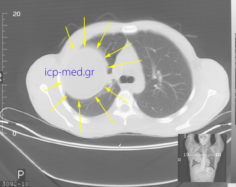 3. Preop CT: Gigantic Hydatid Cyst (18 x 12 cm, YELLOW arrows) of the right lung, abutting the hilum vessels