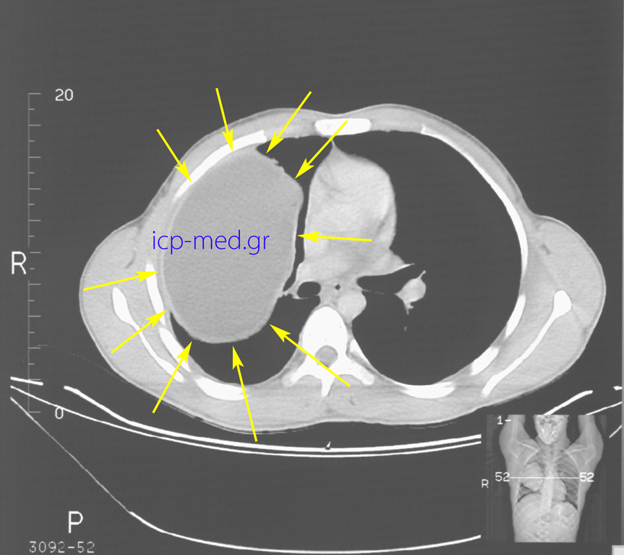 5. Preop CT: Gigantic Hydatid Cyst (18 x 12 cm, YELLOW arrows) of the right lung.