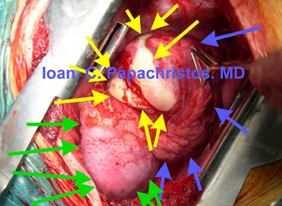 7. Intraop photograph: Sizeable Hydatid Cyst (max.dim. 6 cm, YELLOW) of the pulm. RLLL (BLUE). GREEN: right hemidiaphragm