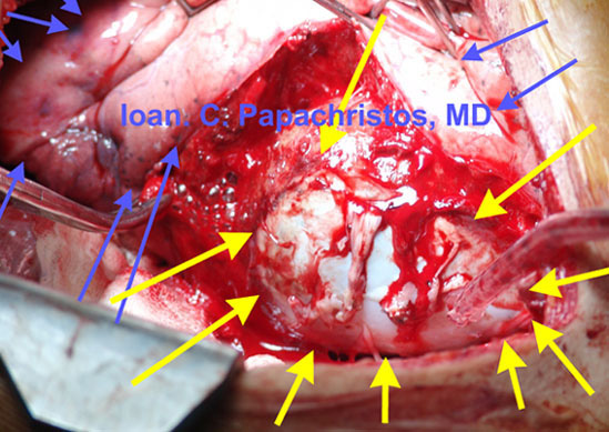 8. Intraop photograph: Large Hydatid Cyst (6.9 x 5.4 cm, YELLOW arrows) of the pulm. LLL (BLUE arrows)