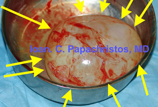 9. Large hydatid Cyst (6.9 x 5.4 cm) of the LLL, entirely enucleated  (specimen)