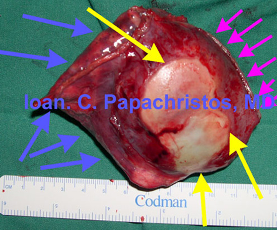 10. Sizeable Hydatid Cyst (m.d. 6 cm, YELLOW arrows) of the RLL, wedgely resected. GREEN: wedge resection margins (specimen)