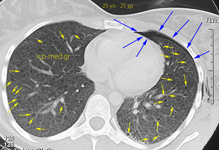 1. CT: thin-walled bullae, pneumothorax (left-sided) & surg. emphysema in a 25-yo ♀