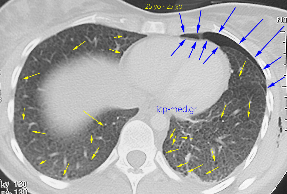 3. CT: thin-walled bullae, pneumothorax (left-sided) & surg. emphysema in a 25-yo ♀
