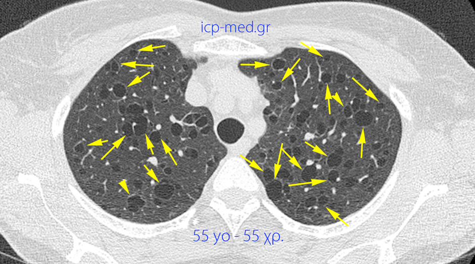 4. CT: numerous Large bullae in a 55-yo post-menopausal♀