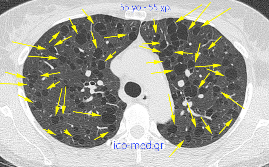 5. CT: numerous Large bullae in a 55-yo post-menopausal♀