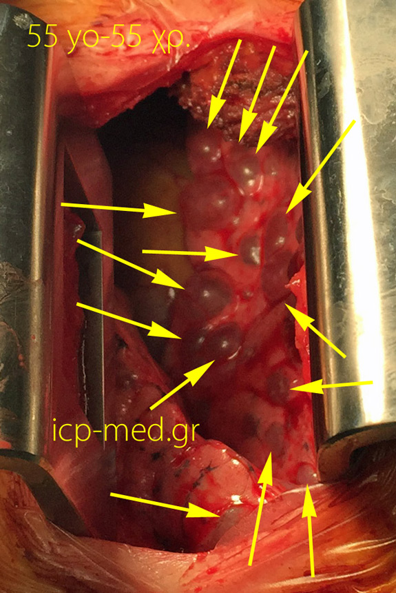 7. IntraOp photogr. of multiple bullae (YELLOW arrow) in a 55-yo ♀