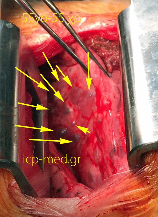 8. IntraOp photogr. of multiple bullae (Yellow arr.) in a 55-yo ♀