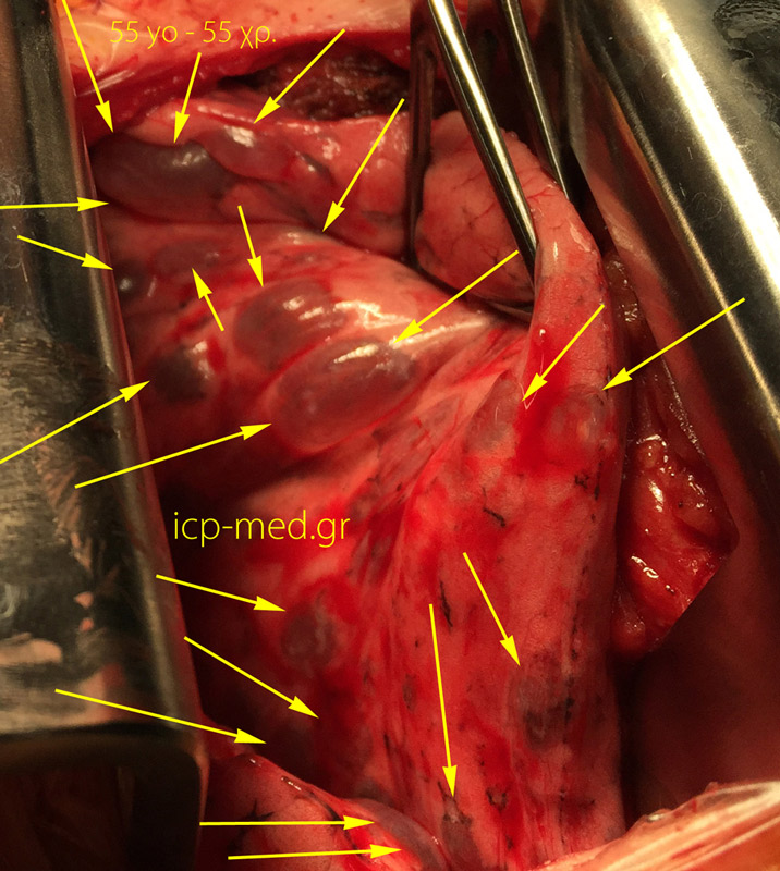 9. IntraOp photogr. of multiple bullae (Yellow arr.) in a 55-yo ♀