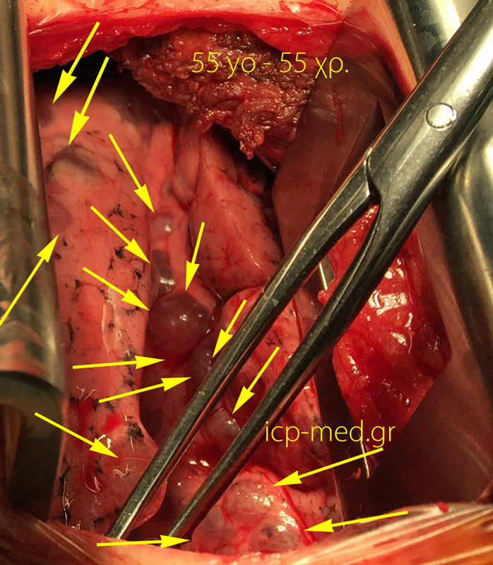 10. IntraOp photogr. of multiple bullae (Yellow arr.) in a 55-yo ♀