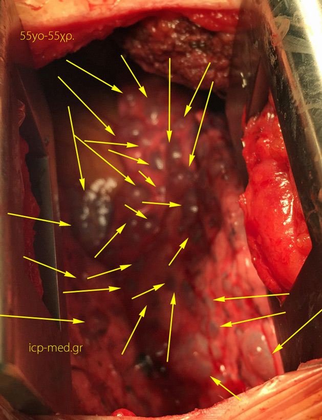 11. IntraOp photogr. of multiple bullae (Yellow arr.) in a 55-yo ♀