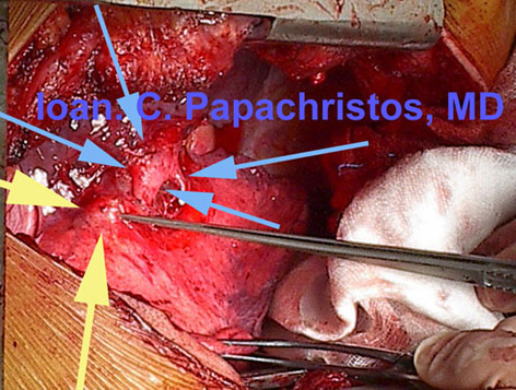 YELLOW arrows: Mucoepidermoid Cancer (LLL). BLUE: branches of the Pulm. art.