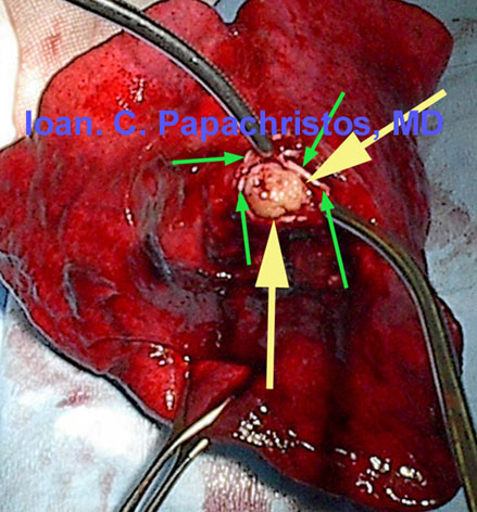 YELLOW arrows: Mucoepidermoid Carcinoma. GREEN: bronchial stump