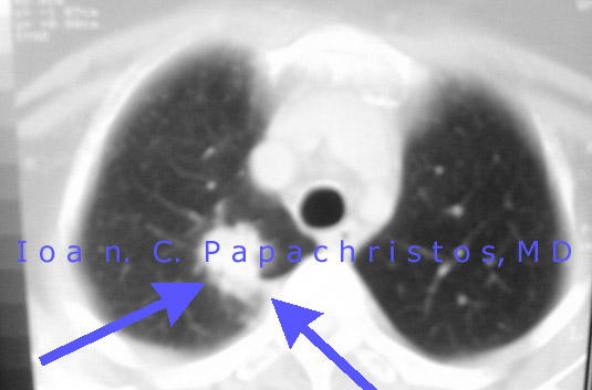 Preop CT scan of adenocarcinoma