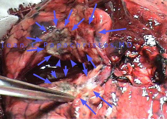 Upper Bilobectomy specimen: In Vitro transection, to reveal appearance/texture. Anthracotic appearance due to accumulation of coal due to cigarettes' smoke inhalation