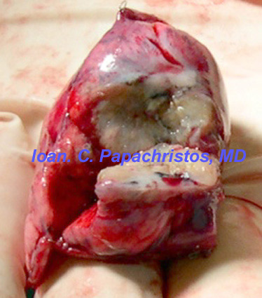 In Vitro transection of adenocarcinoma specimen: necrosis seen at the centre