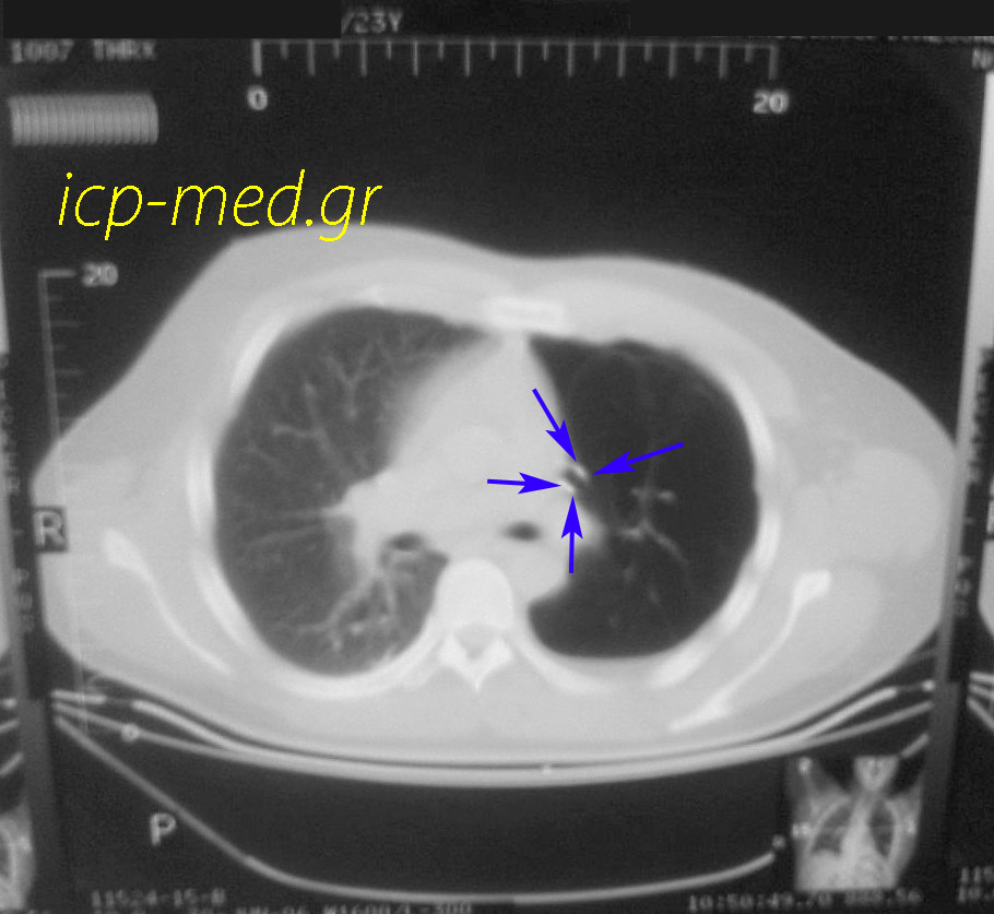 3. Chest CT: vascular desertion on the left side (left pulmonary artery stenosis) & Pneumothorax