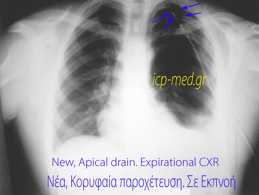 5. The new, apical chest drain inserted for treatment of the pneumothorax ‘finally caused’