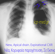 macleodcxr03newdrain.jpg