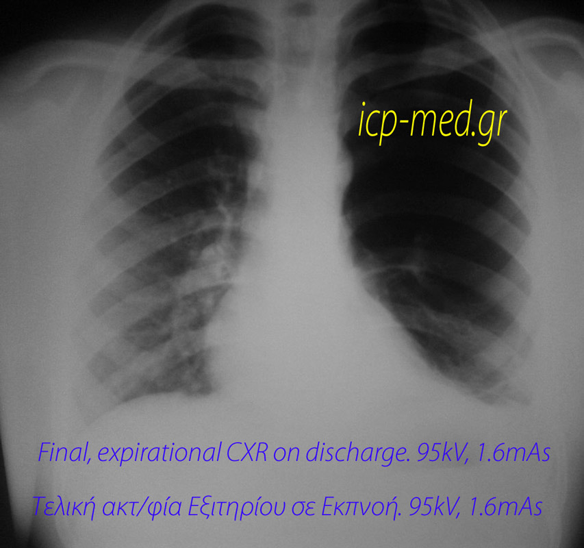 6. Final, ‘under–penetrating,’ expirational CXR upon discharge home