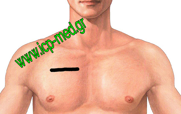 1. Drawing of a right parasternal incision of Mediastinotomy in black (can also be left–sided)