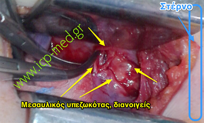 3. The mediastinal pleura (yellow) is incised for exploring a mediastinal lesion