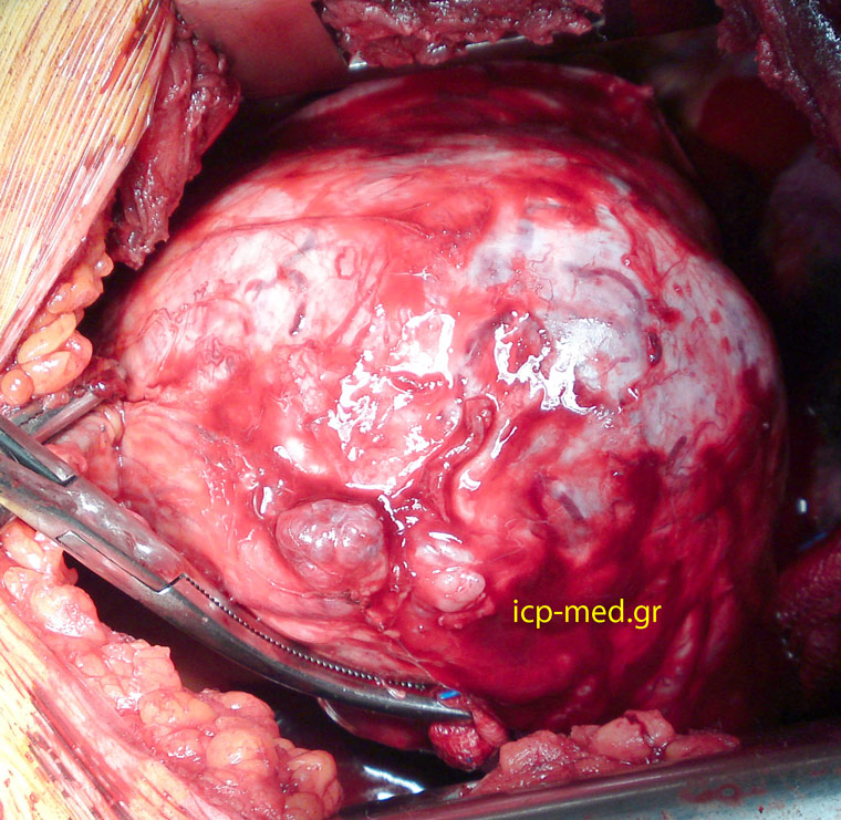 3.Thymoma, seen through left thoracotomy (bed of the 5th rib)
