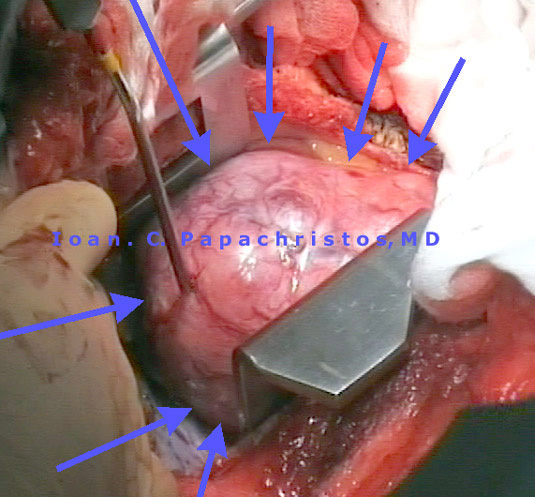 7.Type AB Thymoma, seen through right thoracotomy (bed of the 4th rib)
