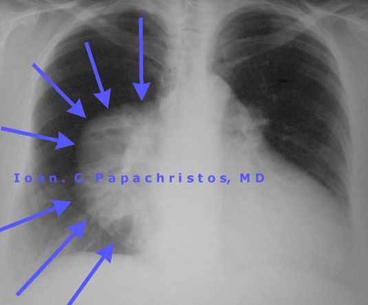 8.Preop CXR: BLUE arrows point to the tumour (thymoma)