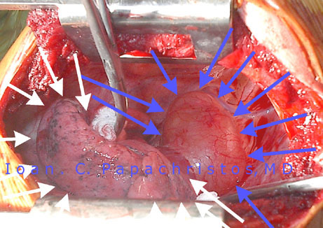1.Neurofibroma (BLUE arrows) behind the left lung, at the Posterior Mediastinum of a 27-yo male