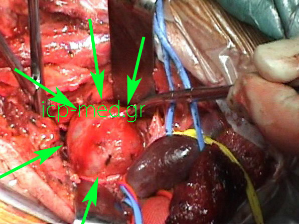 2.Ganglioneuroma (GREEN arrows) in a 24-yo male. Goldstraw's approach