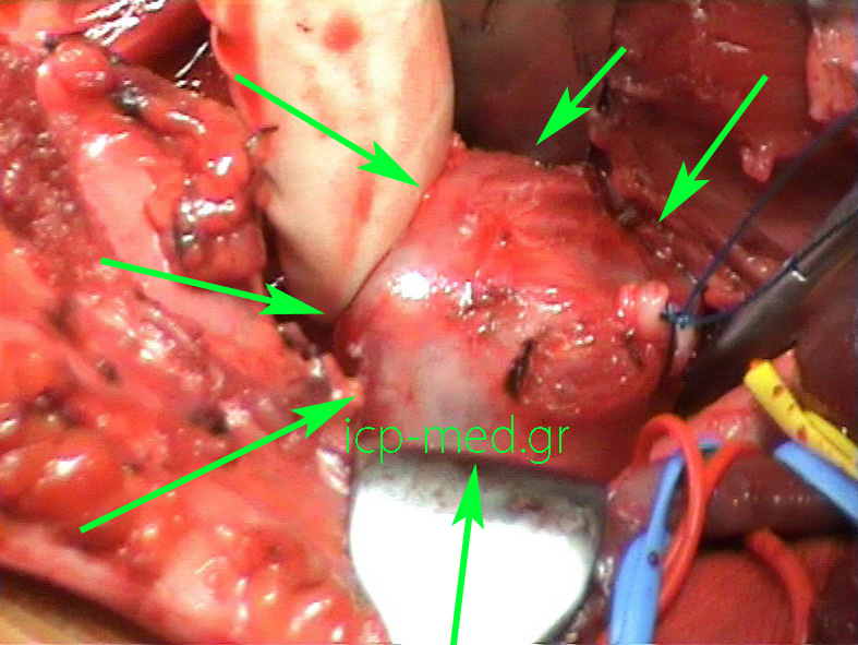 3.Same case (GREEN). VESSEL LOOPS: Blue: internal jugular vein, Yellow: common carotid art., Red: vagus nerve