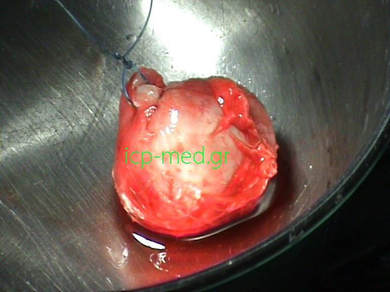 4.Specimen of neuroganglioma resected