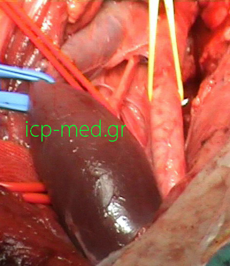 5.Post resection of the tumour. VESSEL LOOPS: Blue: internal jugular vein, Yellow: common carotid art., Red: vagus nerve