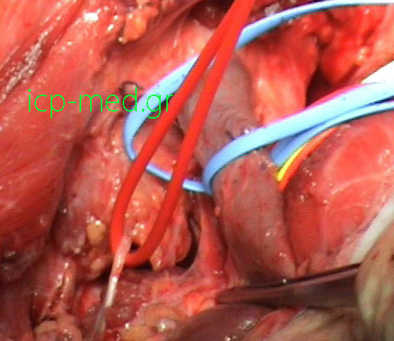 6.Post resection of the tumour. VESSEL LOOPS: Blue: internal jugular vein, Red: phrenic nerve