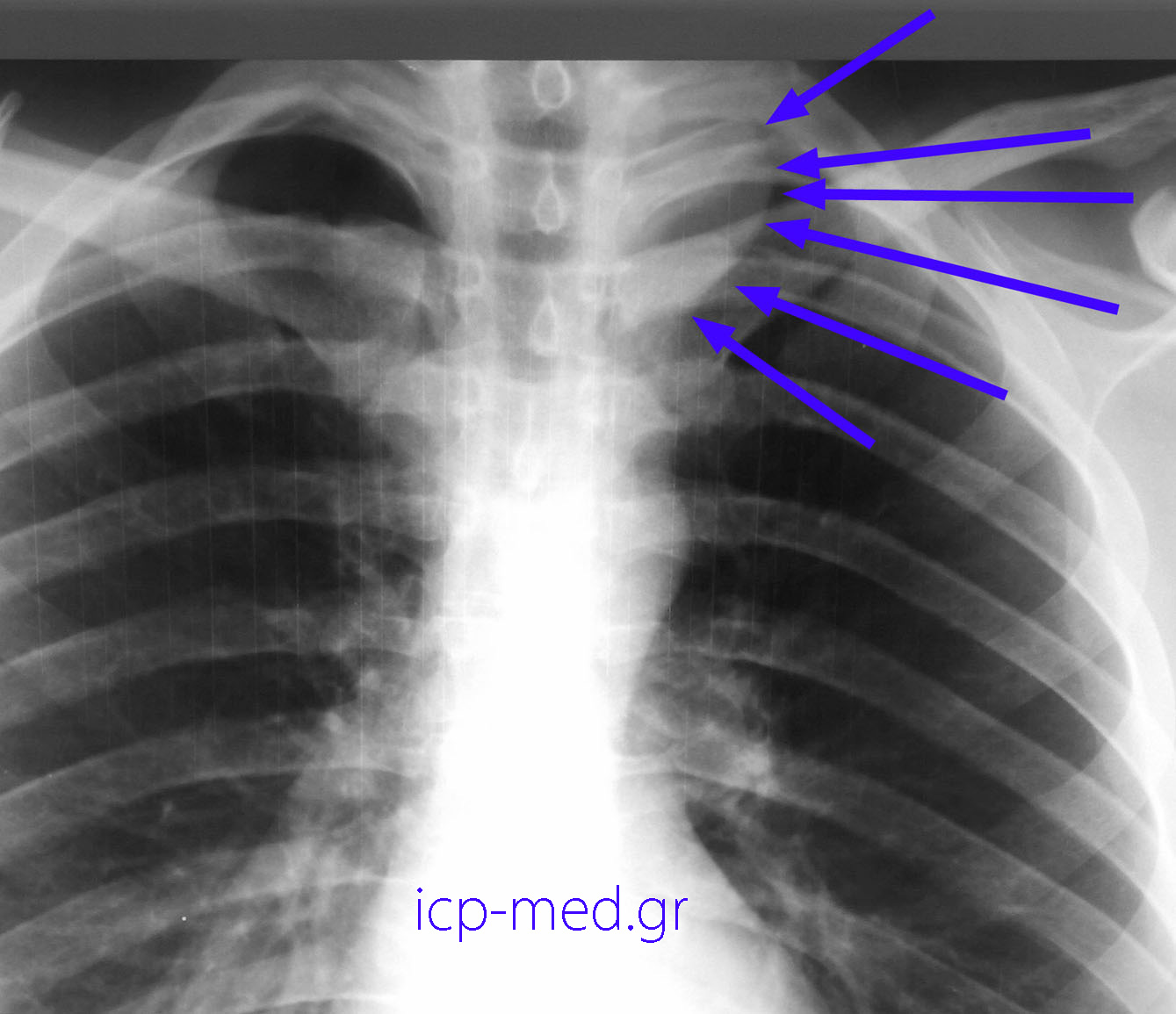 7.Preop CXR (neuroganglioma)