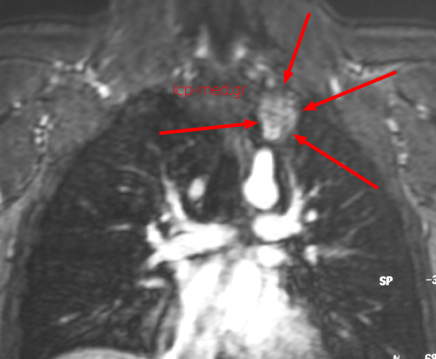 8.Preop MRI (neuroganglioma)