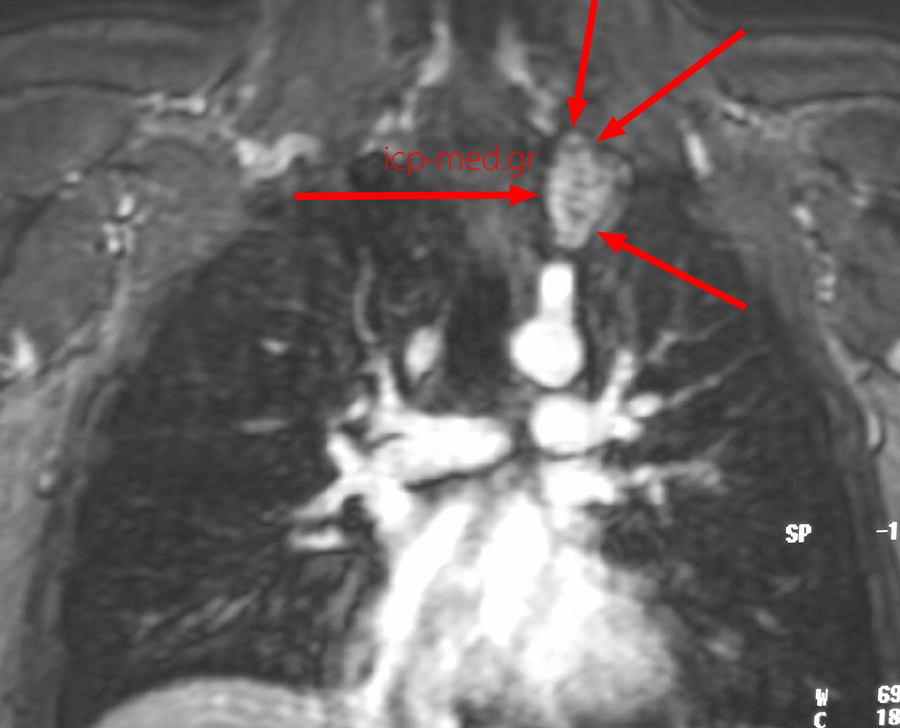 9.Preop MRI (neuroganglioma)