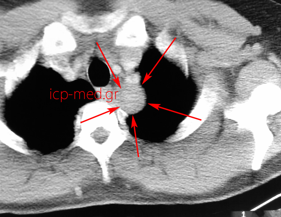 11.Preop CT (neuroganglioma)