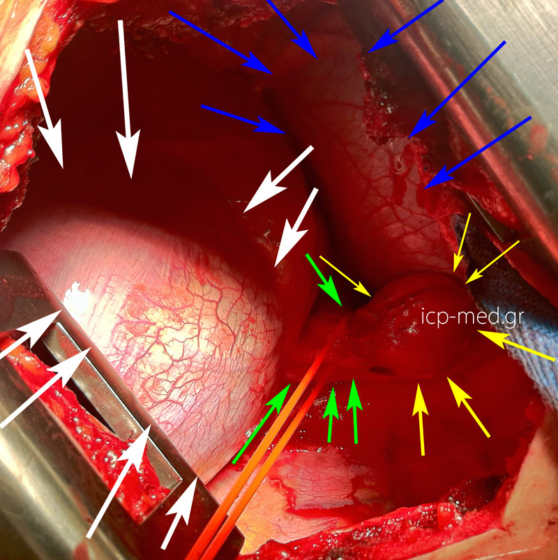 1.YELLOW: Leiomyoma (tumour). GREEN: oesophagus (red loop passed around it). BLUE: pericardium. WHITE: diaphragm