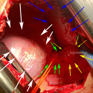 oesophagleiomyoma1.jpg