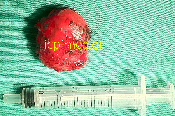 2.Specimen: esophageal leiomyoma resected