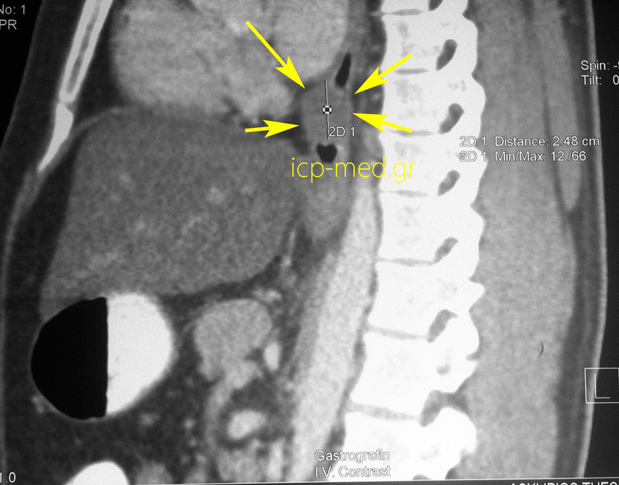 3.Preop imaging: sagittal view