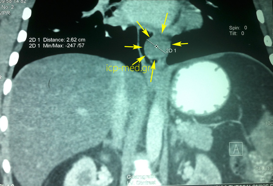 4.Preop imaging: coronal view