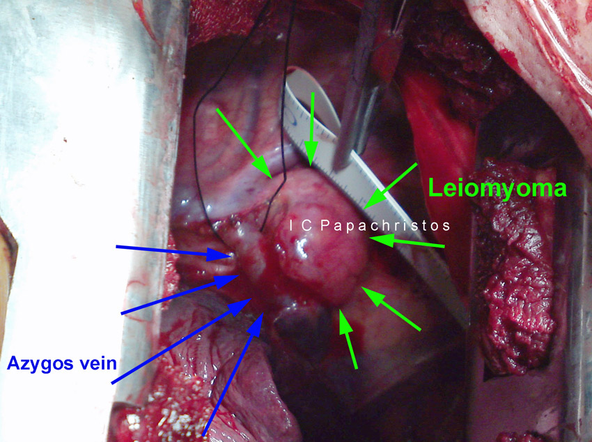 6.GREEN: Leiomyoma of the esophagus. BLUE: azygos vein (right thoracitomy)